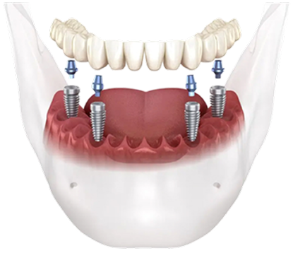 All On 4 implant bridge and posts