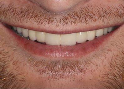 Before — Teeth Whitening