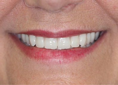 Before — Smile Design
