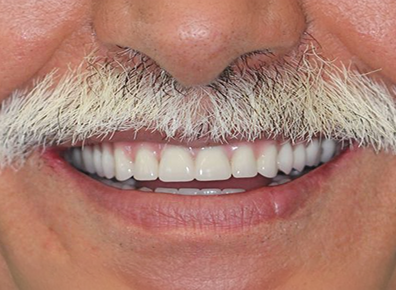 Before — Retainer
