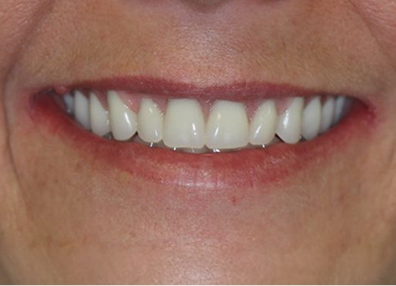 Before — Veneers