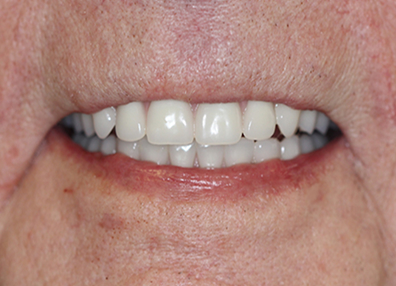 Before — Full Makeover
