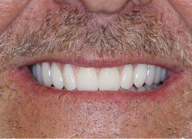 Before — Braces Result