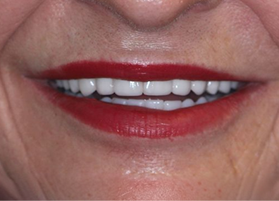 Before — Dental Implant
