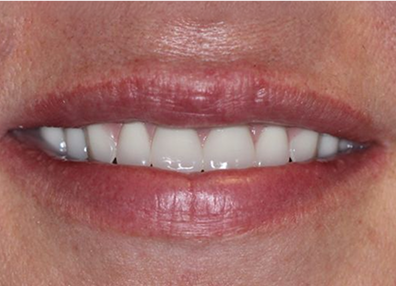 Before — Crown Fitting