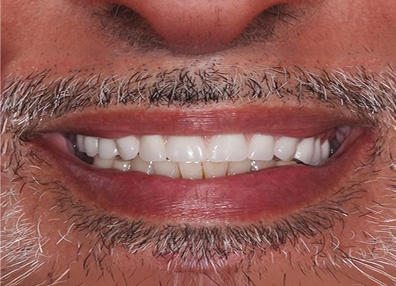 Before — Gum Treatment