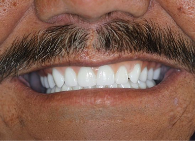 Before — Root Canal