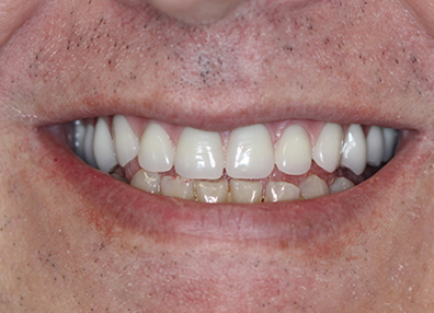 Before — Aligners