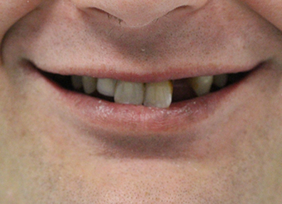 After — Teeth Whitening
