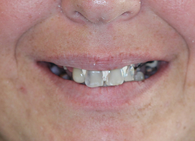 After — Filling