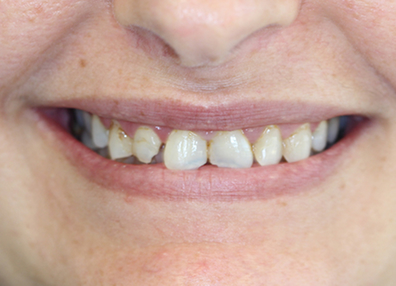 After — Extraction