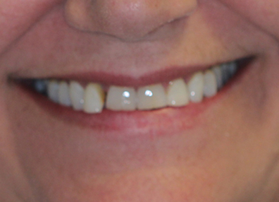 After — Smile Design