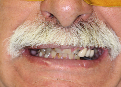 After — Retainer