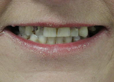 After — Veneers
