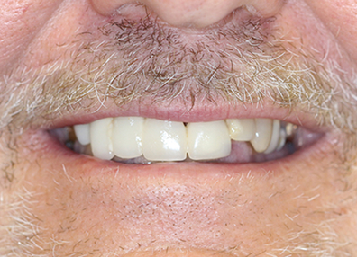 After — Braces Result