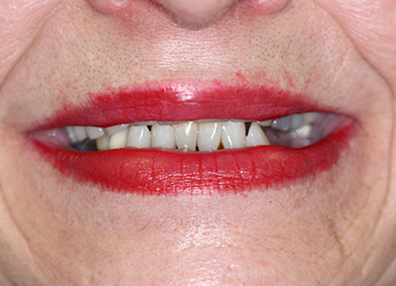 After — Dental Implant