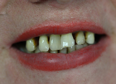 After — Crown Fitting
