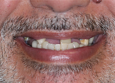 After — Gum Treatment