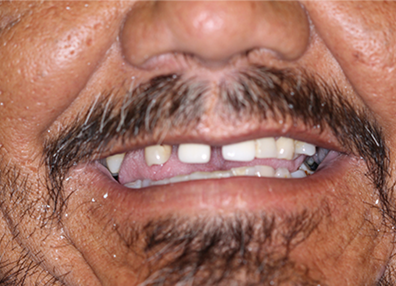 After — Root Canal