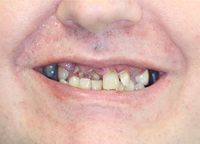 After — Aligners